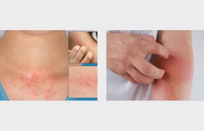 Sống khỏe 360 -  Viêm da tiếp xúc (12-12-2020)
